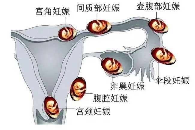 高龄女性可以去泰国做试管吗泰国试管婴儿优点分析