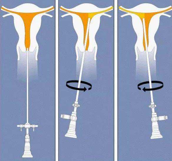 地中海贫血可以做第三代试管婴儿吗？-代妈微信交流